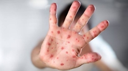 Focolai di morbillo nel mondo: «Sono 21 le tipologie dirompenti»