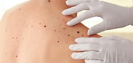 Melanoma, in Italia salgono al +7% i casi: fondamentale la prevenzione