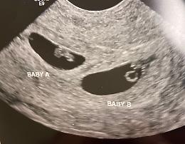 Vietato dalla legge, ma finanziato dai miliardari: la Silicon Valley punta su embrioni "corretti" per bimbi geneticamente modificati