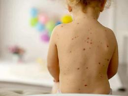 Morbillo, la Sicilia &egrave; la regione con meno vaccinati di tutt&rsquo;Italia: solo il 67,8% e l'immunit&agrave; di gregge diventa un'utopia