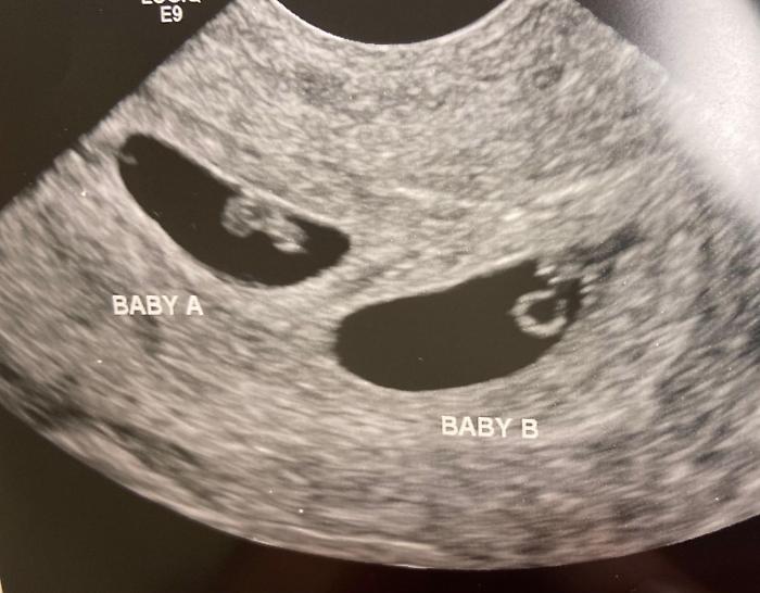 Vietato dalla legge, ma finanziato dai miliardari: la Silicon Valley punta su embrioni "corretti" per prevenire malattie e inseguire QI più alto